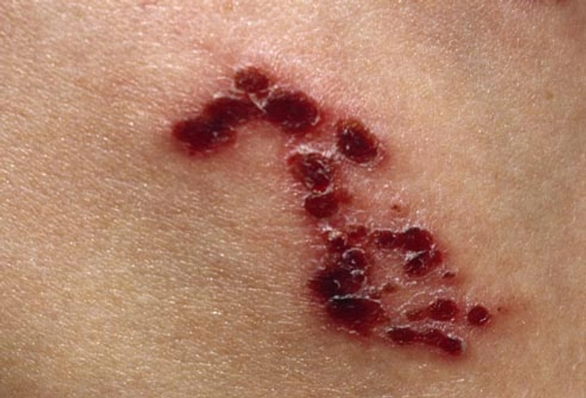 Picture Of Shingles Blisters
