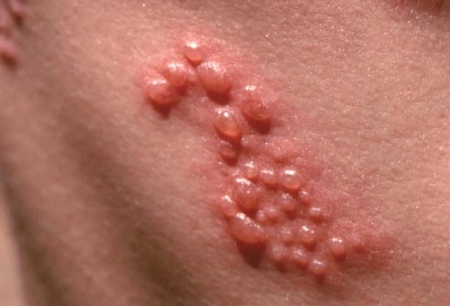 Picture Of Shingles