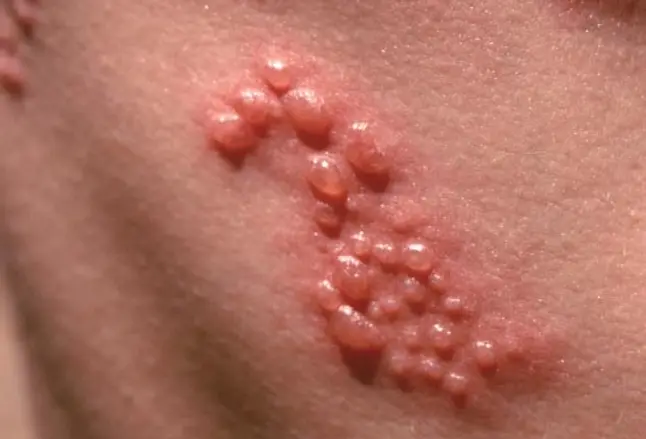Small blisters at the onset of shingles oubreak