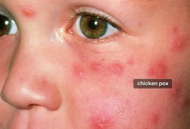 Is Shingles Contagious?