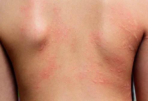 Signs of a Severe Allergic Reaction