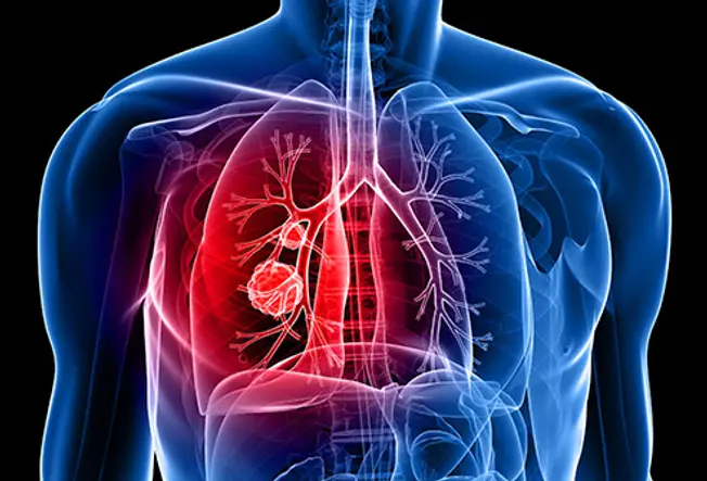 Is It Lung Cancer?