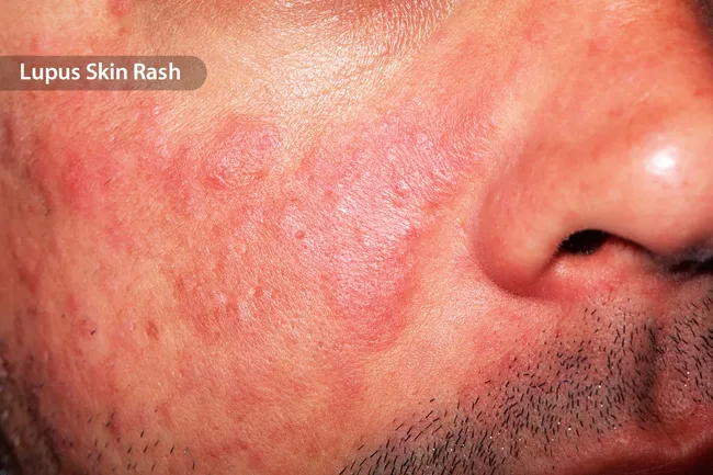 photo of lupus skin rash on man's cheek