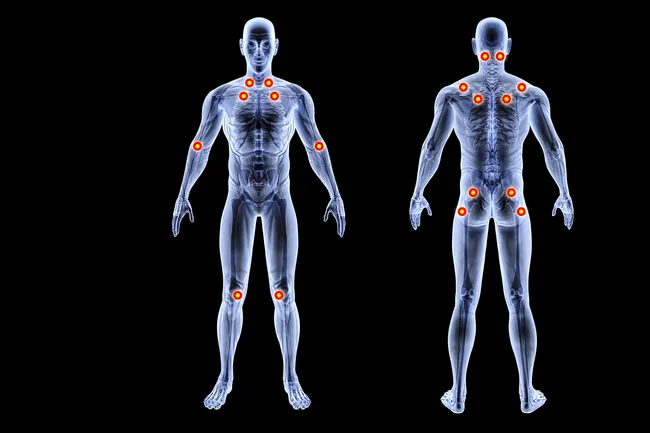 photo of fibromyalgia pain points on human body