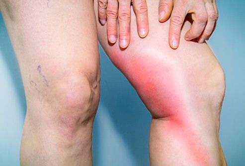 leg with redness and inflamation