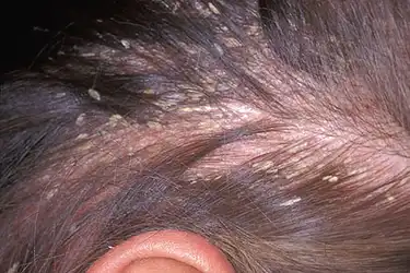 white scalp in hair)
