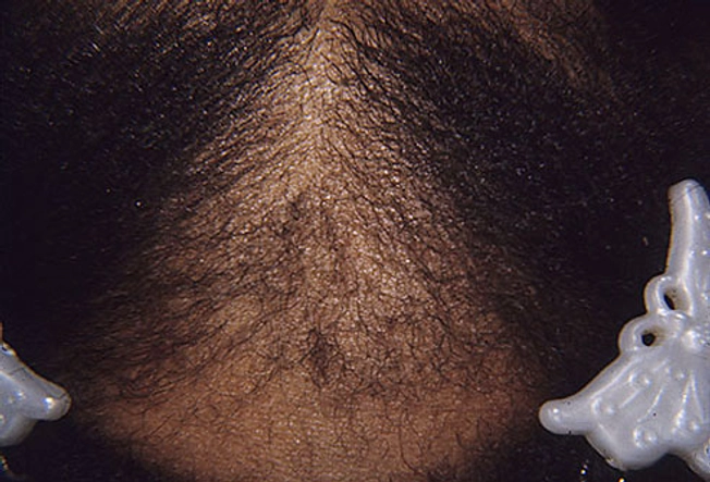 Traction Alopecia Damages Follicles