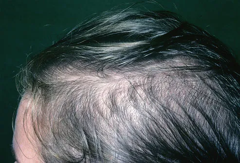 Woman with hair loss