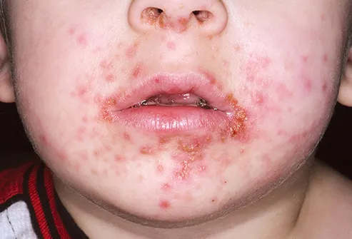 Pictures of Skin Infections