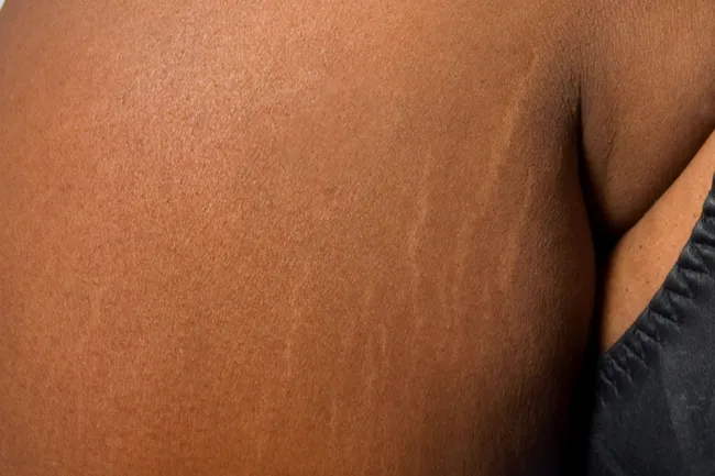 photo of stretch marks on arm