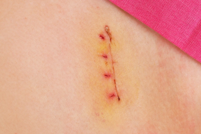 Tips to Care for Your Surgery Wound