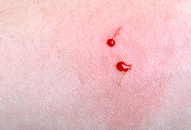 Pit Viper Bite Symptoms