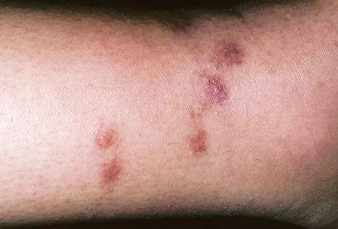 Images Of Spider Bites On Legs