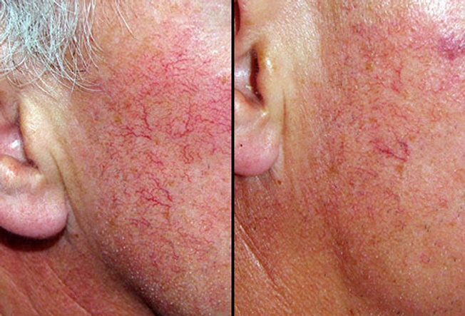Laser Therapy: Before and After