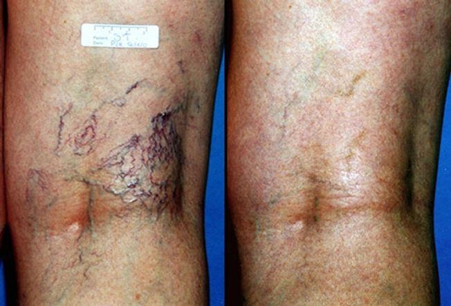 Sclerotherapy: Before and After