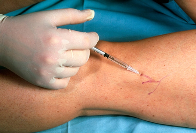 Treatment: Sclerotherapy