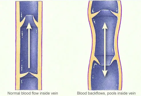 illustration of blood flow in varicose vein