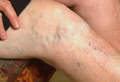Spider and varicose veins on woman's legs