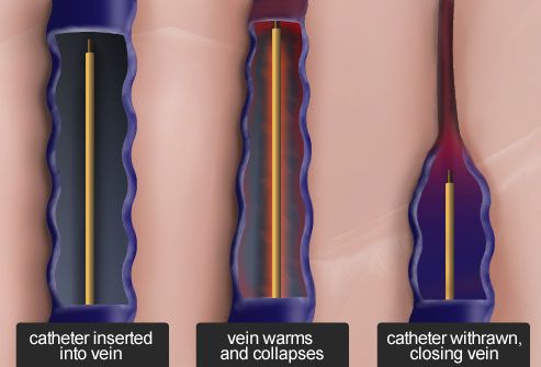Radiofrequency ablation for large varicose veins