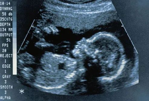 Ultrasound Scan Of Fetus