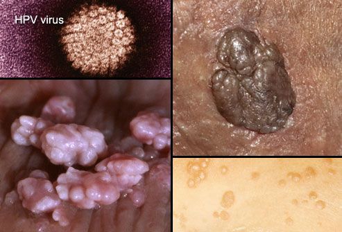 Collage of Genital Warts