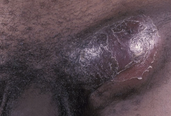 LGV (Lymphogranuloma Venereum)