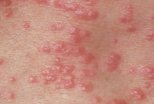 Skin Infected With Scabies