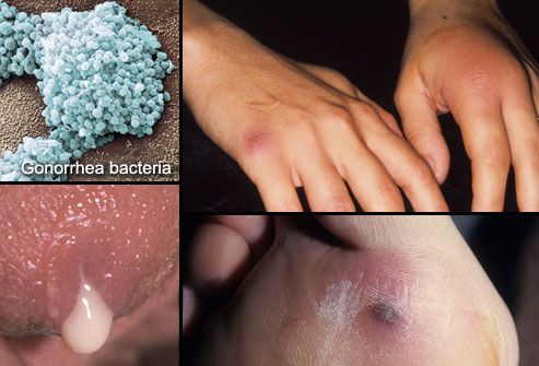 Collage Of Gonorrhea Infections