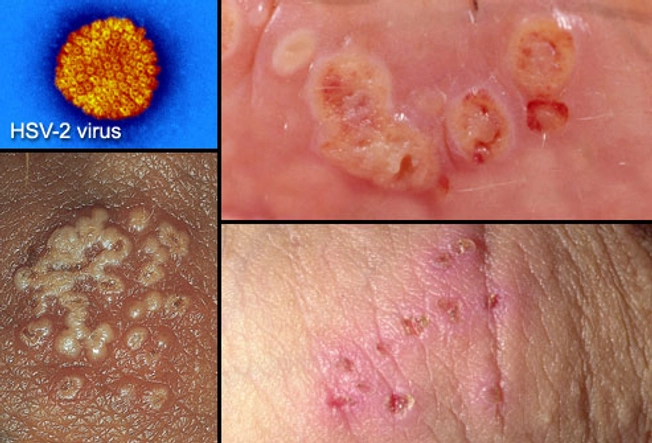 Herpes simplex virus such as 2