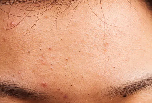 Corticosteroid injection for acne side effects