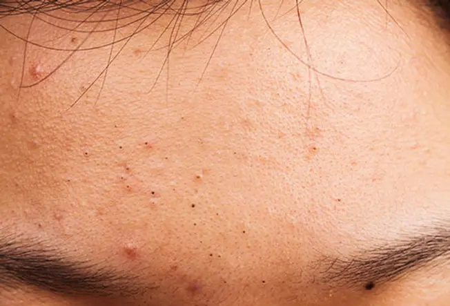 Thinkstock rf photo of forehead covered in acne