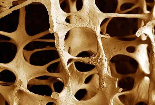 bone with osteoperosis
