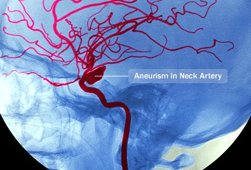 angiogram of arterial aneurysm
