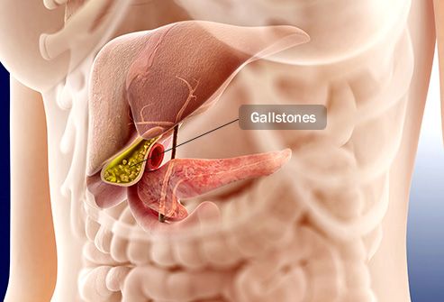 gallstones illustration