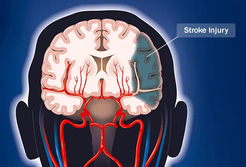 scan of brain showing stroke injury