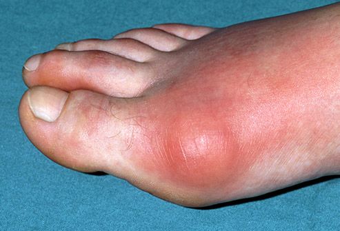 mans foot with gout