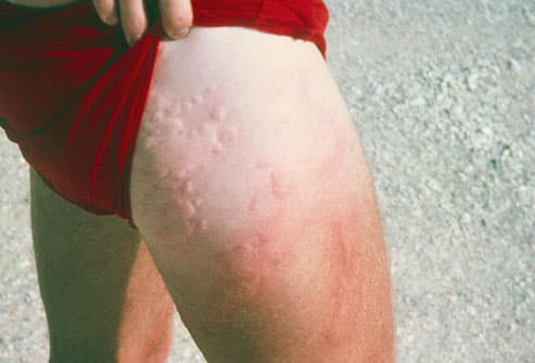 Red rash from a jellyfish sting on a man's thigh