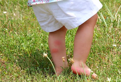 Chigger bites on back of toddler's leg