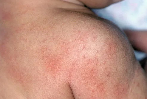Heat rash on a baby's shoulder 
