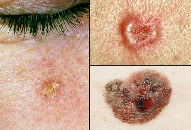 Collage of precancerous skin growths