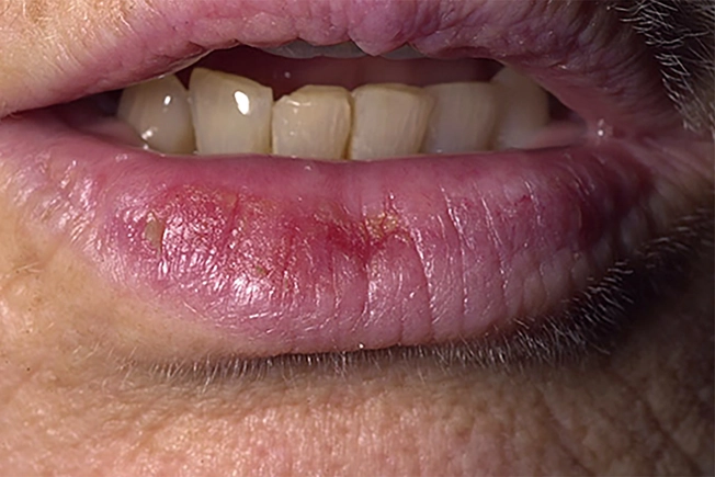Actinic Cheilitis (Farmer’s Lip)