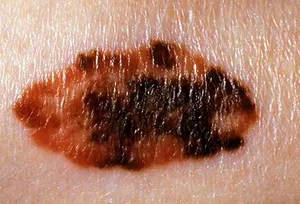 photo of melanoma