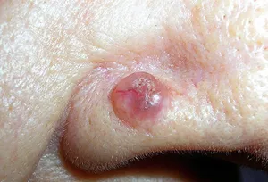 photo of basal cell carcinoma on the nose