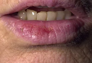 Actinic cheilities on the lower lip 