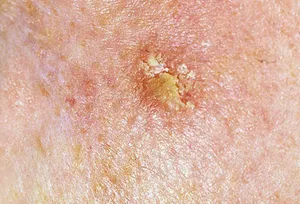 Actinic keratosis, a precancerous skin condition