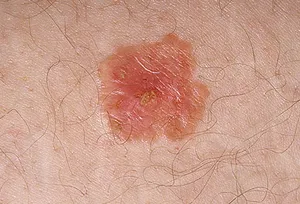 Bowen Disease on the surface of the skin