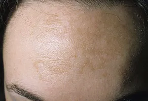 Melasma (pregnancy mask) on forehead