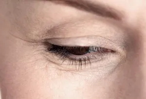 Lines and wrinkles around woman's eye