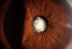 Close-up of a mature cataract