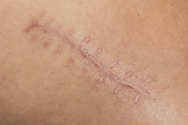 photo of scar